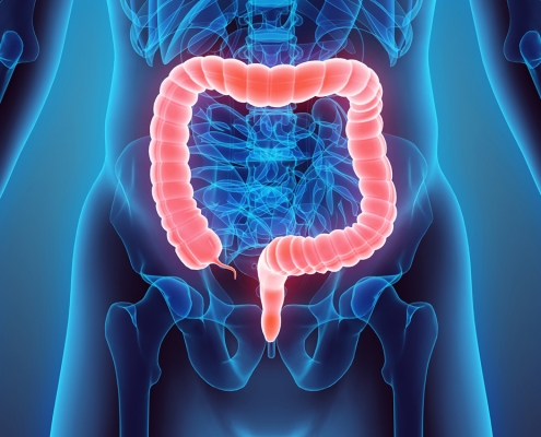 Divertículos do Cólon 11 Diverticulos do Colon
