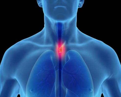 Câncer de Esôfago 4 cancer esofago angioskope