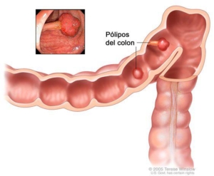 polipos do colon