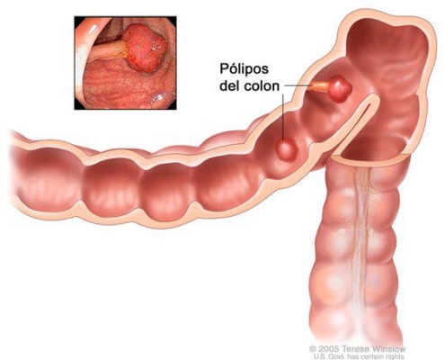 Pólipos no Cólon 1 polipos do colon